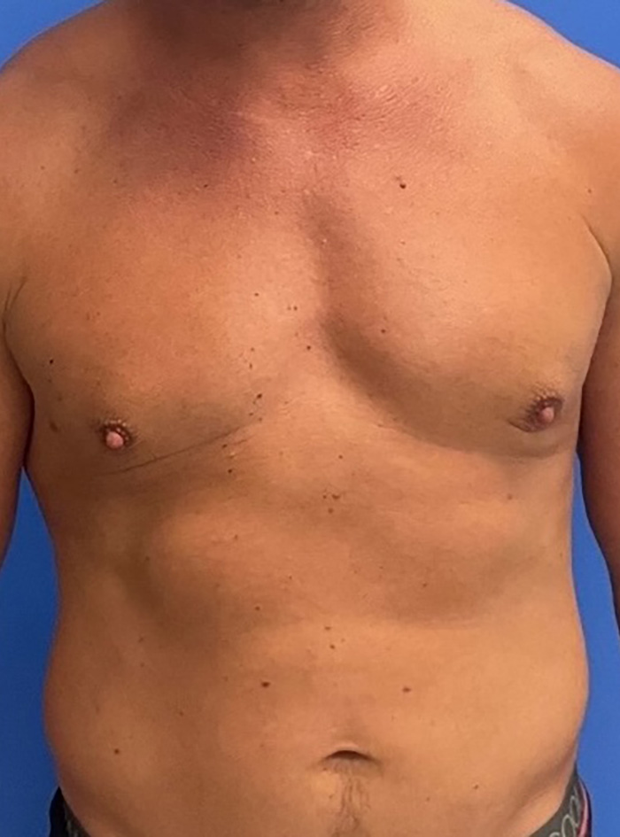 Case--1145 | After Gynecomastia 1