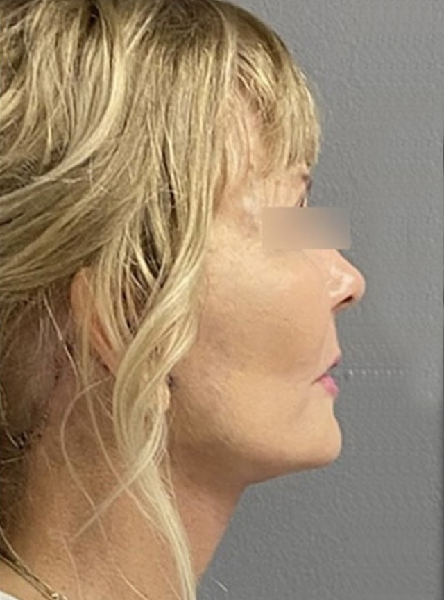 Case--5839 | After Facelift and Neck Lift 2