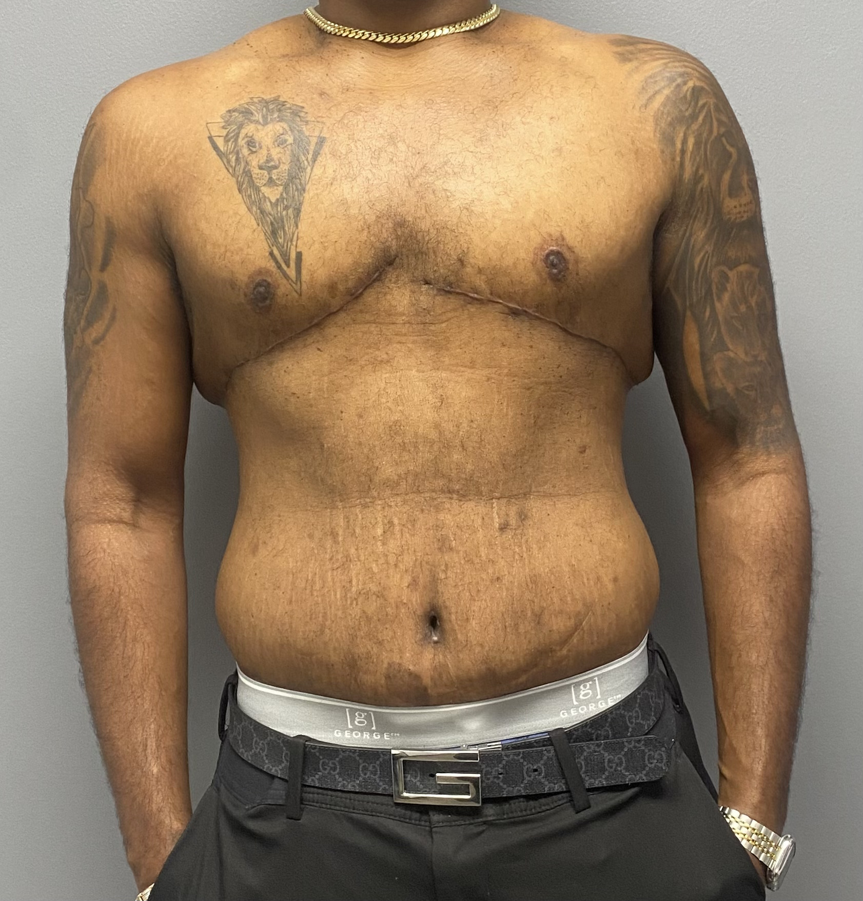 Tummy Tuck, Gynecomastia Excision Miami Beach