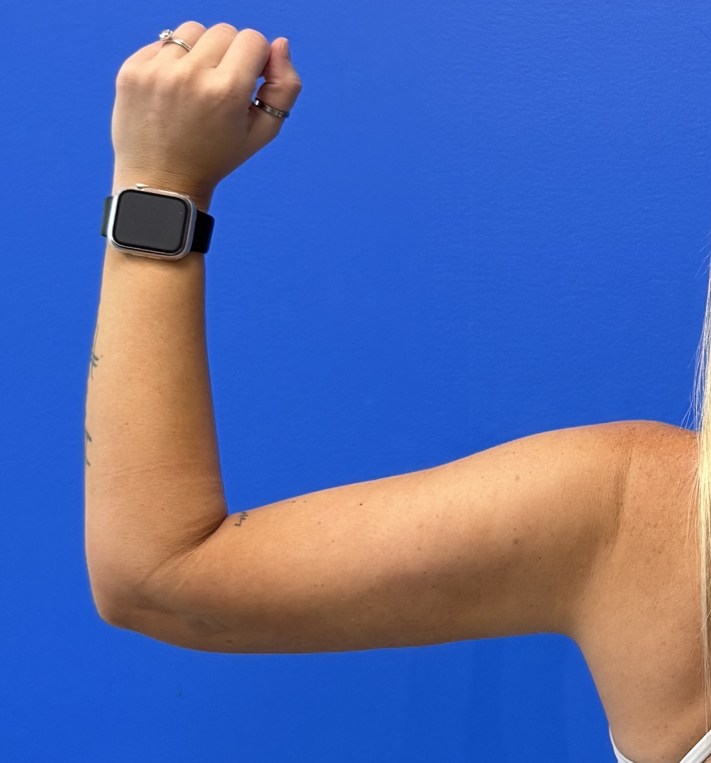 Case--7812 | After Liposuction 4