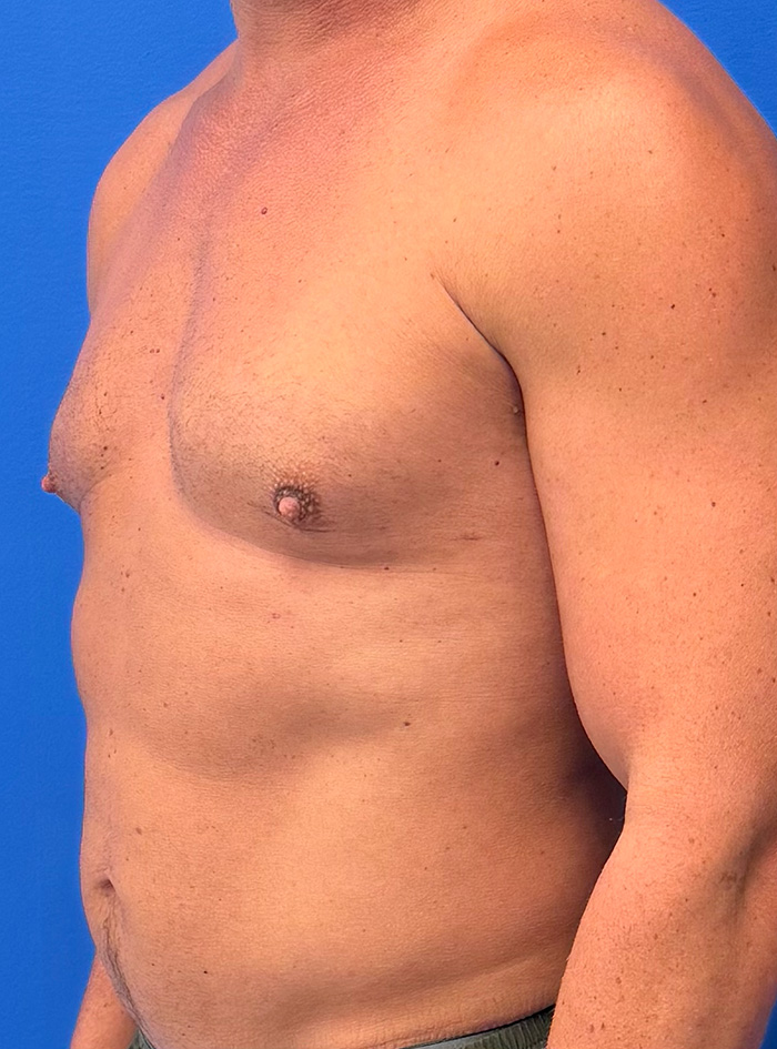 Case--1145 | After Gynecomastia 2
