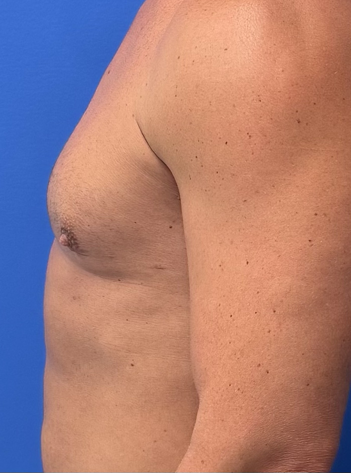 Case--1145 | After Gynecomastia 3