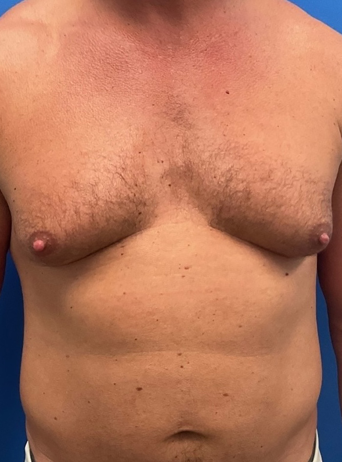 Case--1145 | Before Gynecomastia 1