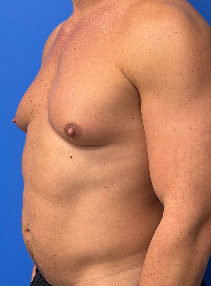 Case--1145 | Before Gynecomastia 2