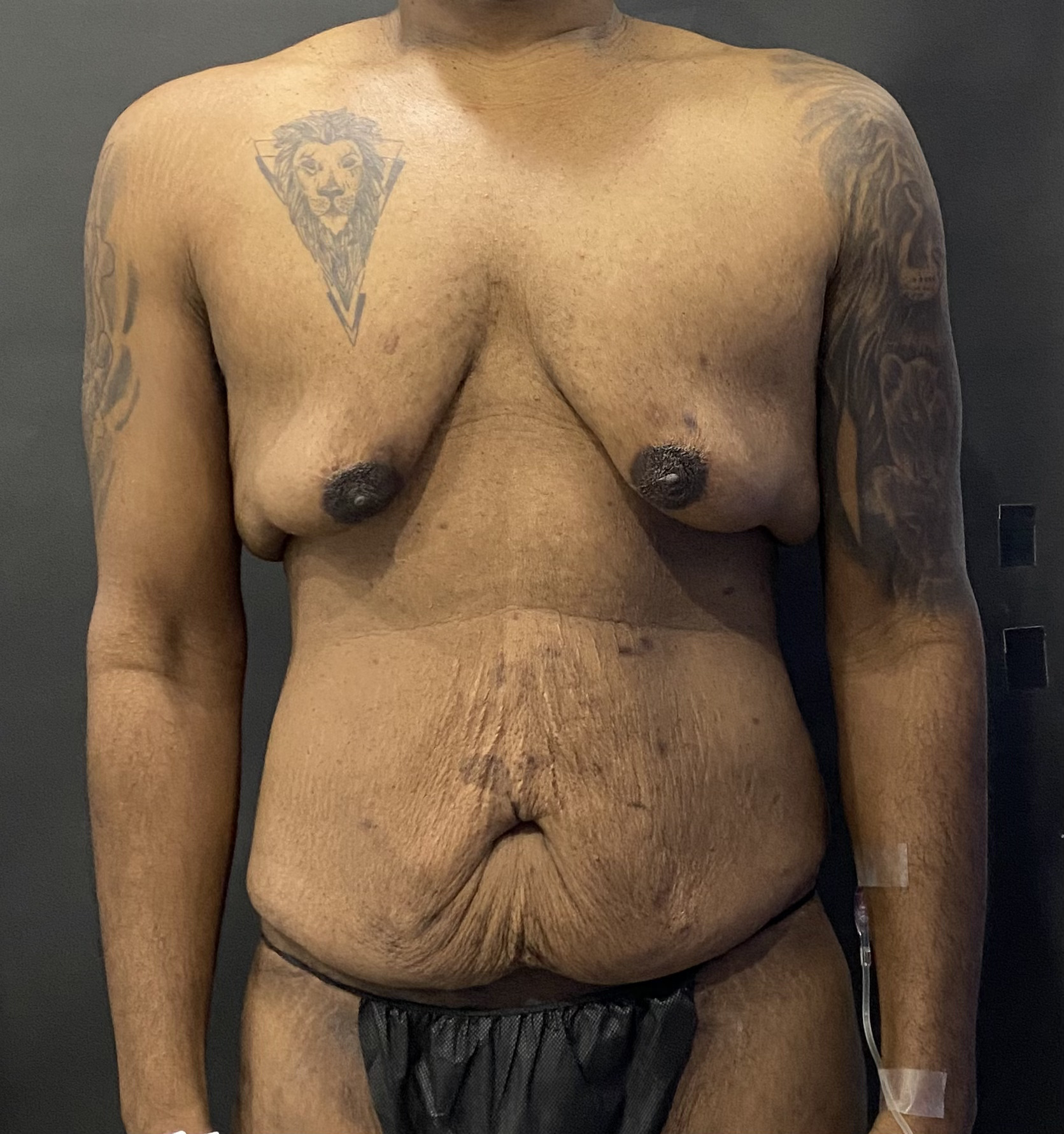 Tummy Tuck, Gynecomastia Excision Miami Beach