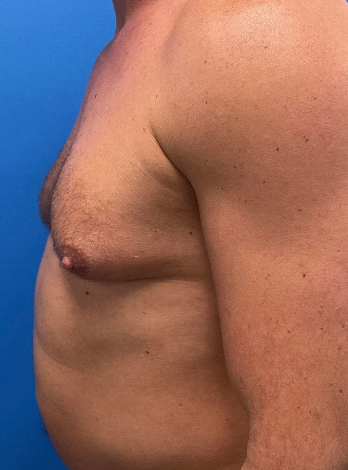 Case--1145 | Before Gynecomastia 3