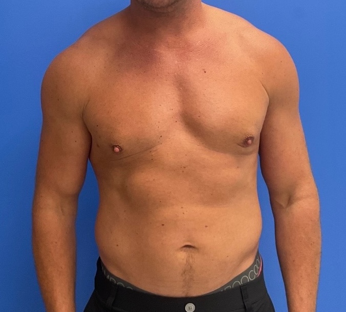 Case--1145 | After Gynecomastia 1