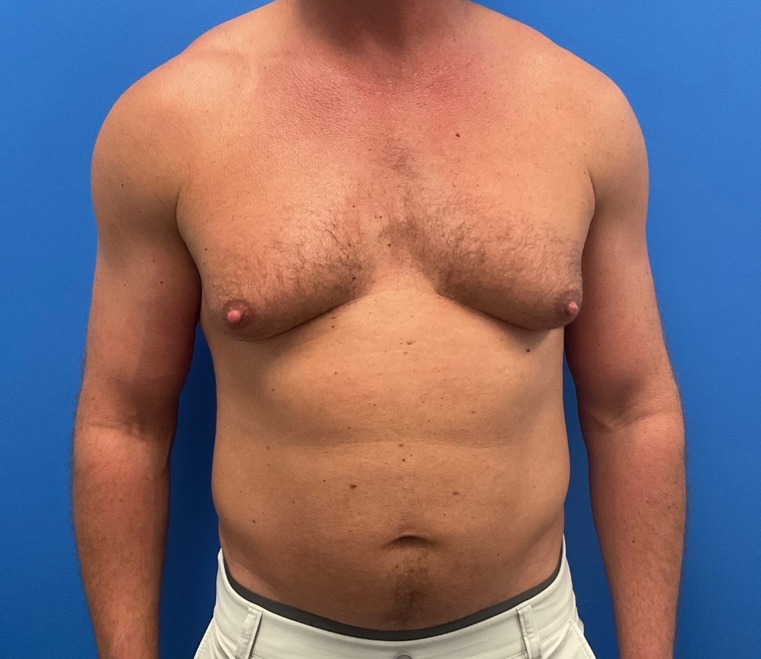 Case--1145 | Before Gynecomastia 1