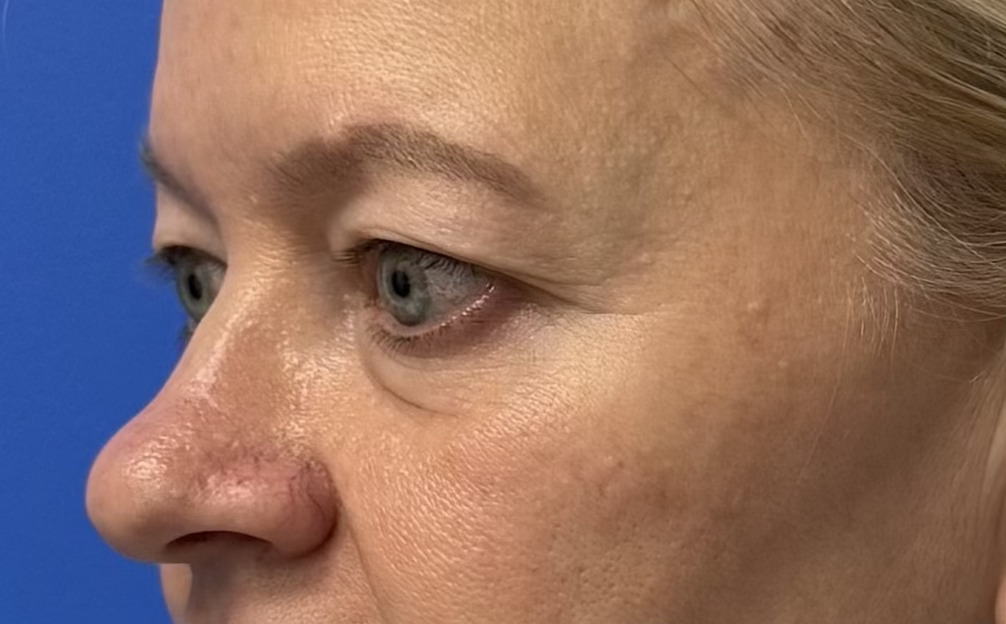 awake surgery upper blepharoplasty miami beach