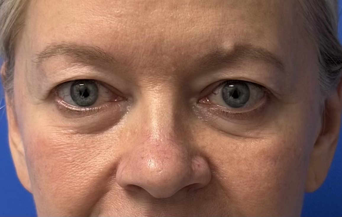 awake surgery upper blepharoplasty miami beach