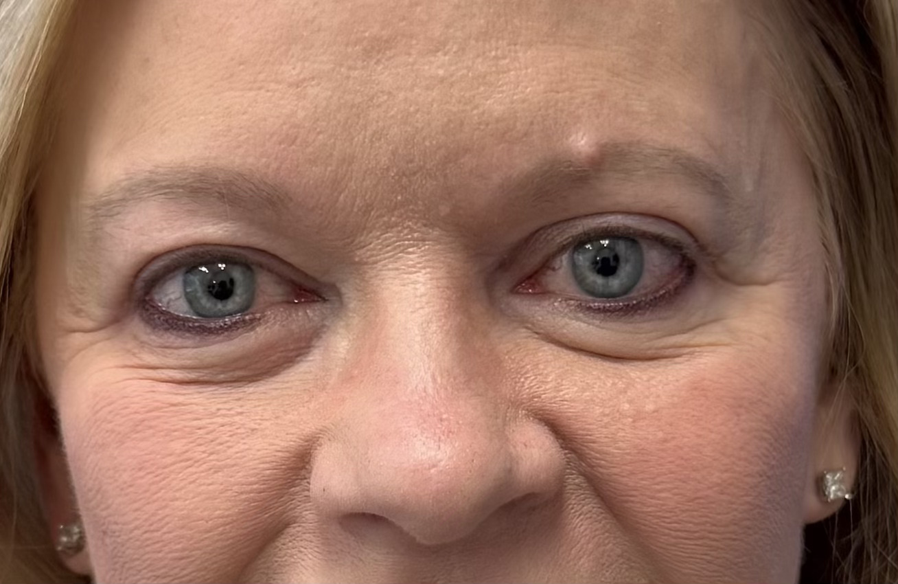 awake surgery upper blepharoplasty miami beach