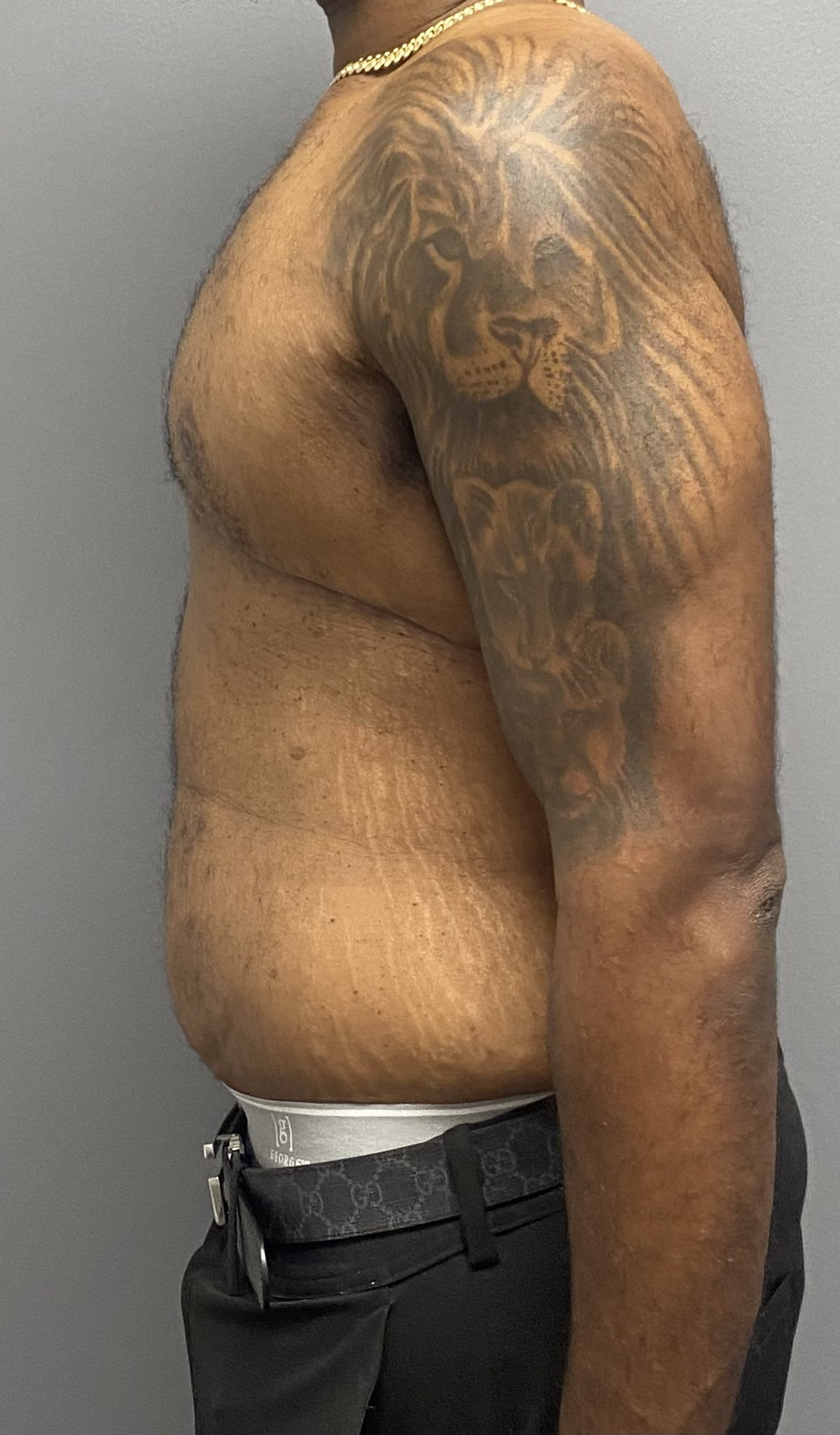 Tummy Tuck, Gynecomastia Excision Miami Beach