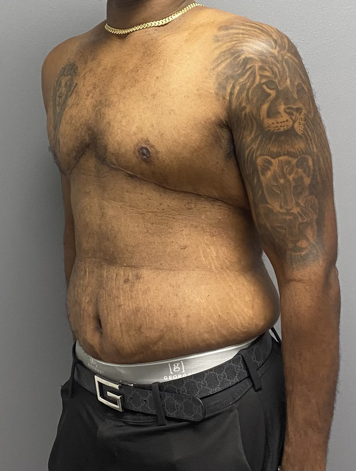 Tummy Tuck, Gynecomastia Excision Miami Beach
