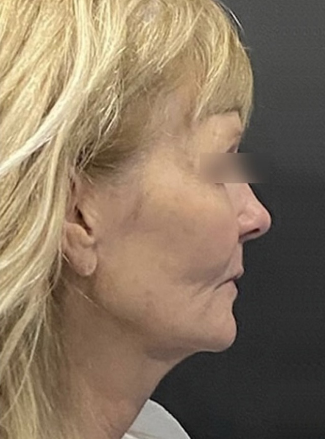 Case--5839 | Before Facelift and Neck Lift 2