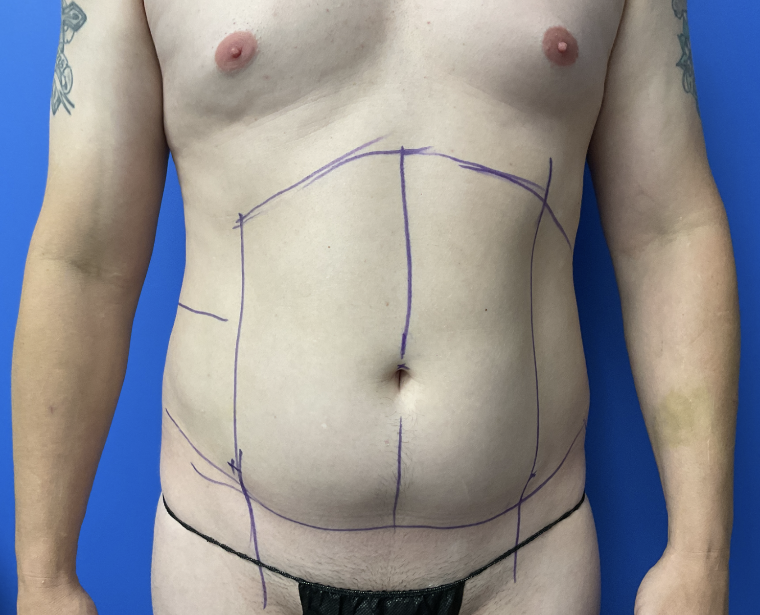 Case--8716 | Before Male Plastic Surgery