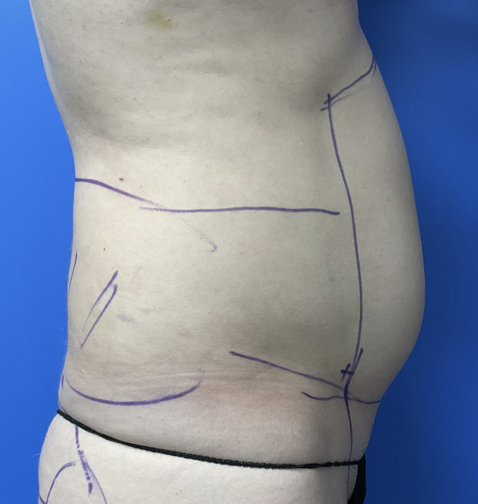 Case--8716 | Before Liposuction 2