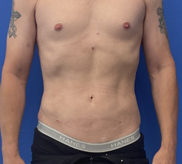 Case--8716 | After Male Plastic Surgery