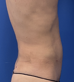 Case--8716 | After Liposuction 2