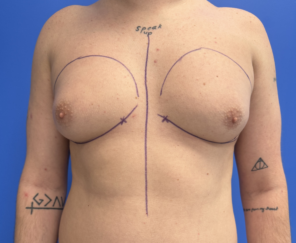 Case--4055 | Before Gynecomastia