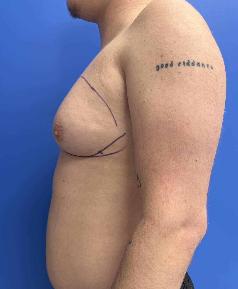 Case--4055 | Before Gynecomastia 3