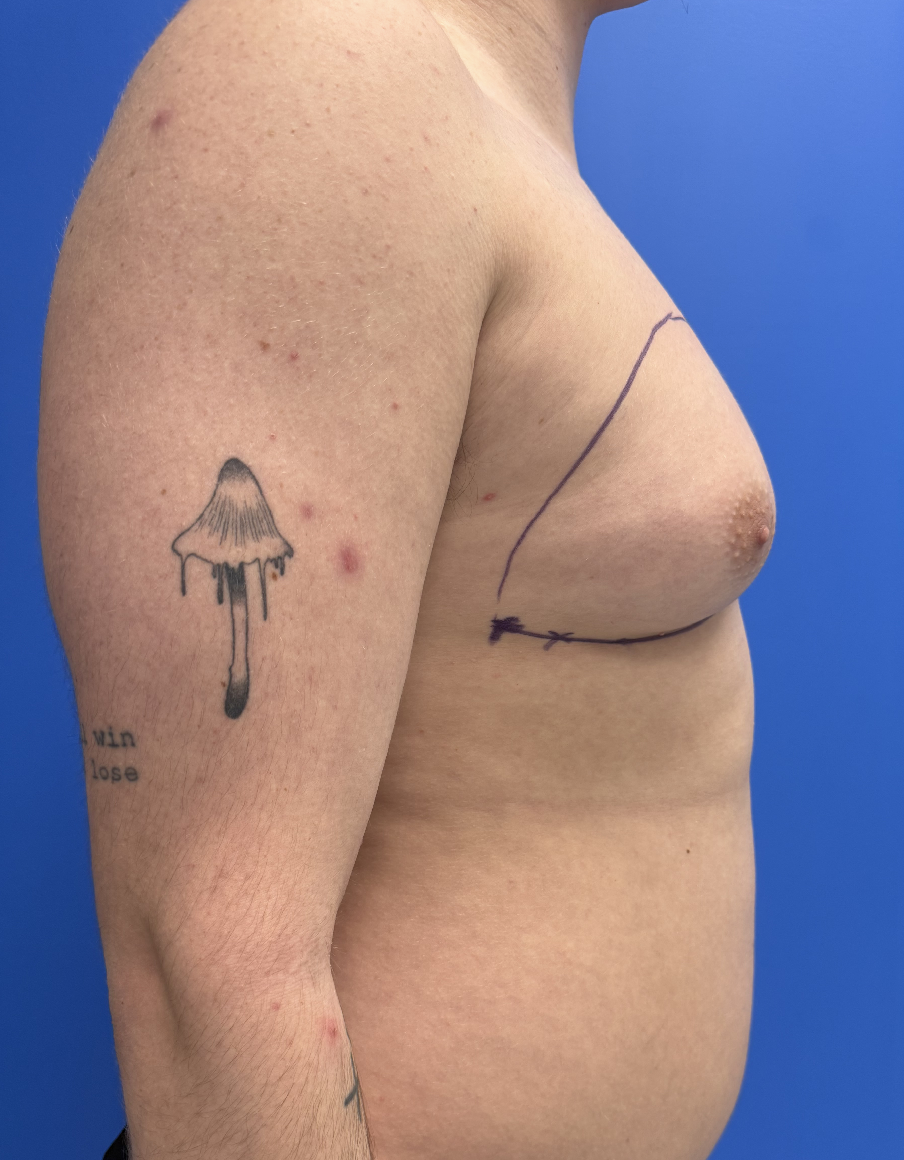 Case--4055 | Before Gynecomastia 2