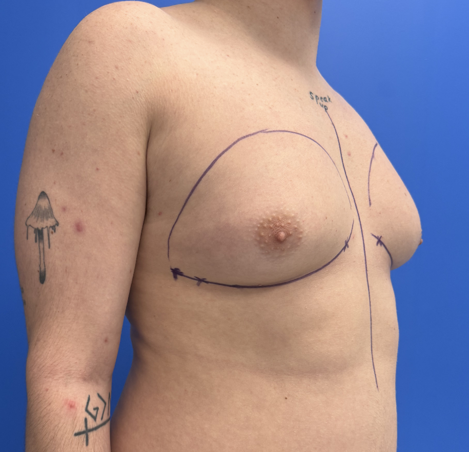 Case--4055 | Before Gynecomastia 4