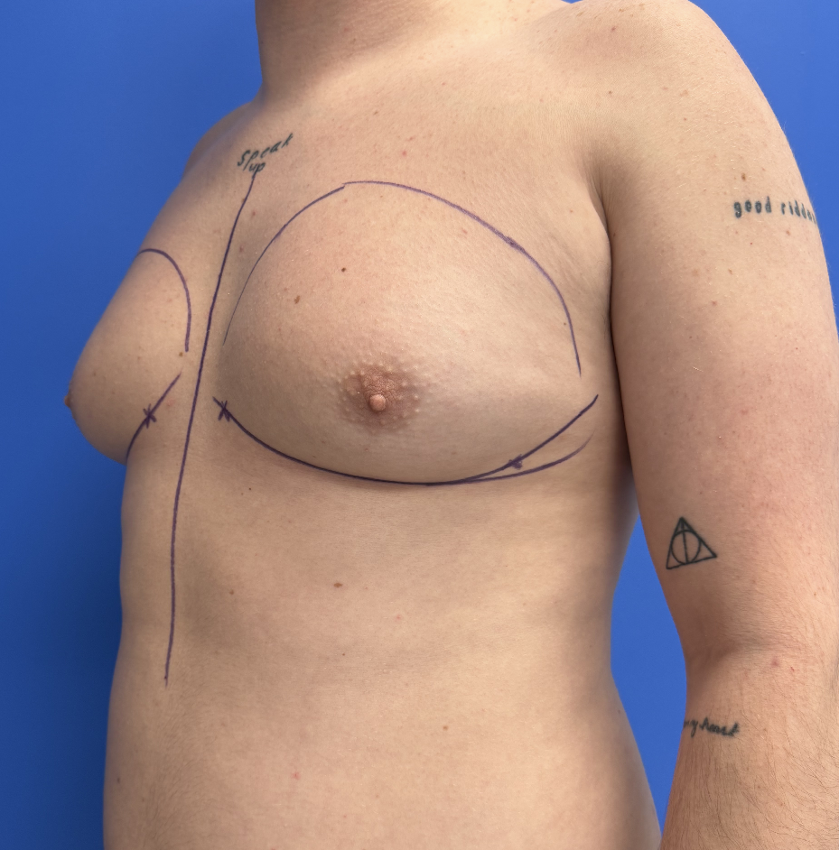 Case--4055 | Before Gynecomastia 5