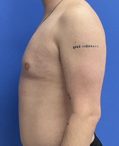 Case--4055 | After Gynecomastia 3