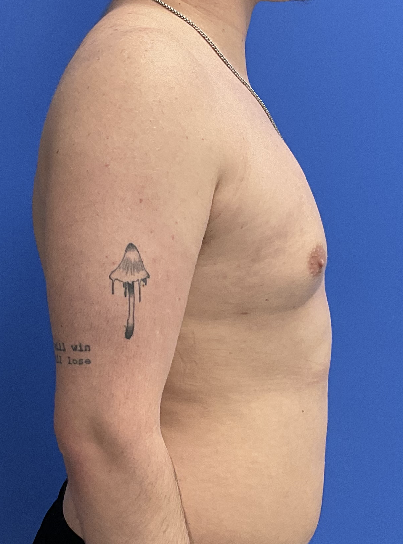 Case--4055 | After Gynecomastia 2