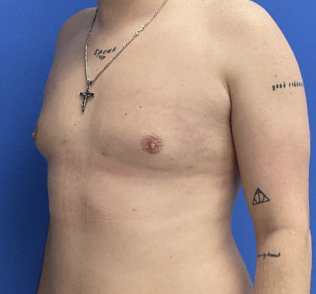 Case--4055 | After Gynecomastia 5