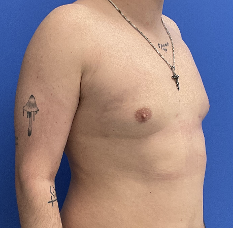 Case--4055 | After Gynecomastia 4