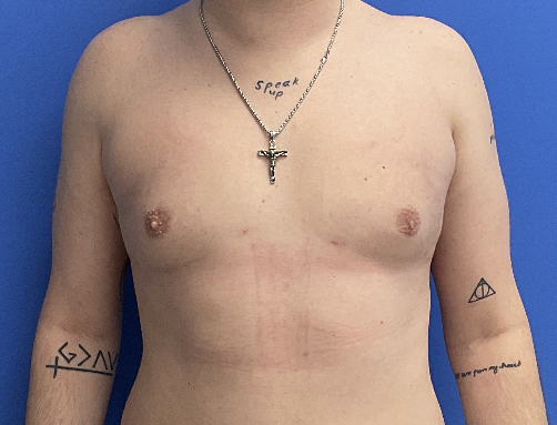 Case--4055 | After Gynecomastia