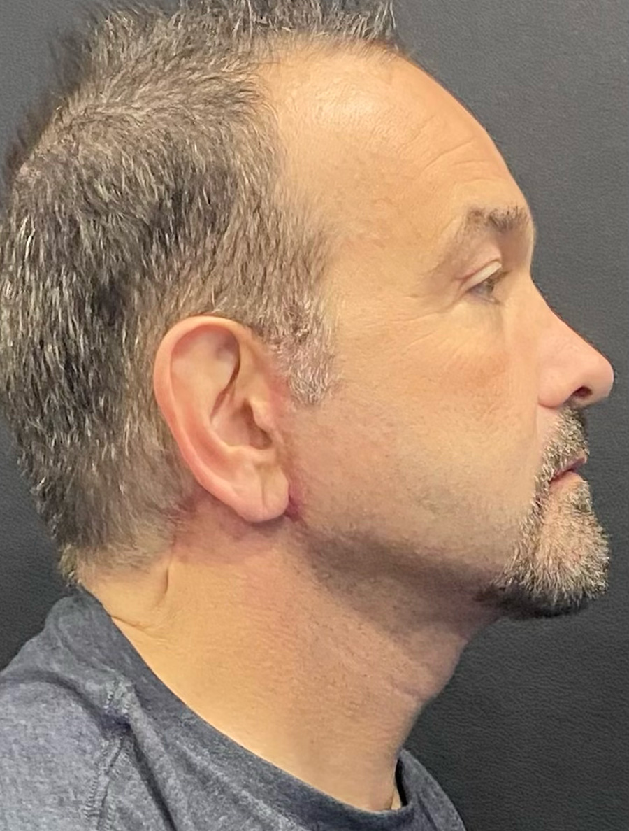 Case--4255 | After Facelift and Neck Lift 2