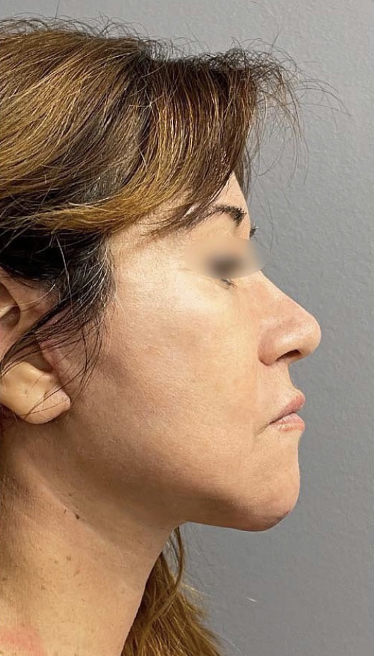 Case--7119 | After Facelift and Neck Lift