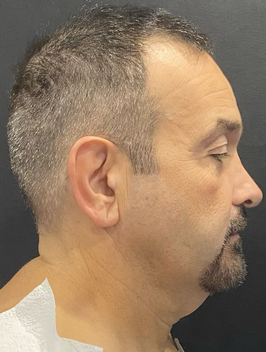 Case--4255 | Before Facelift and Neck Lift 2