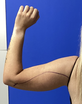 Case--7812 | Before Liposuction 4