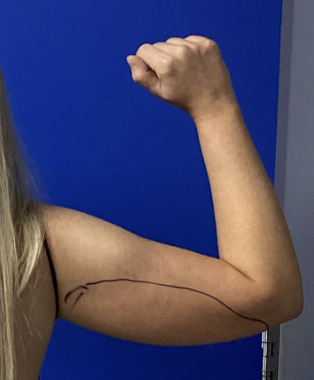 Case--7812 | Before Liposuction 3