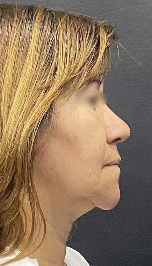 Case--7119 | Before Facelift and Neck Lift