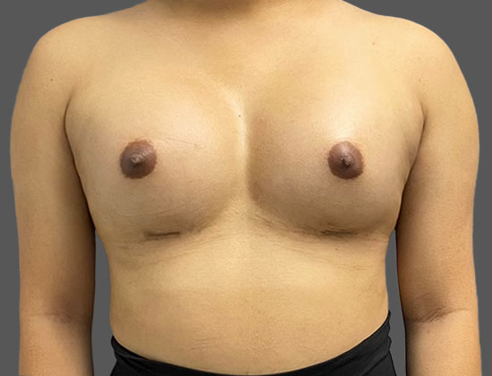 Case--5570 | After Breast Augmentation
