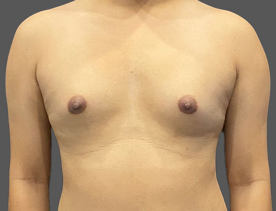 Case--5570 | Before Breast Augmentation