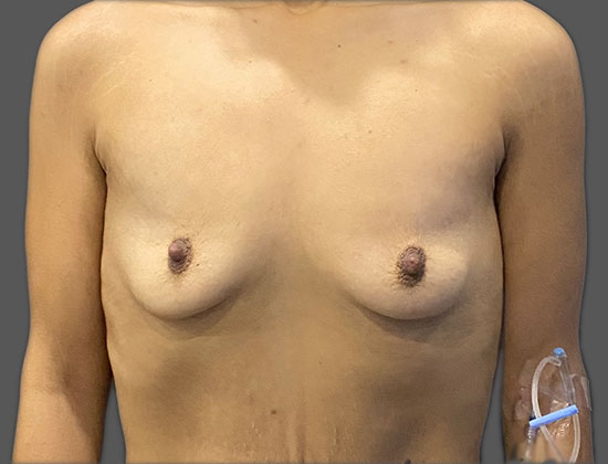 Case--8703 | Before Breast Augmentation