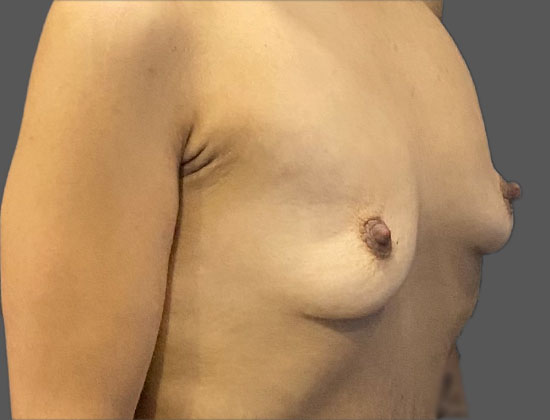 Case--8703 | Before Breast Augmentation 2