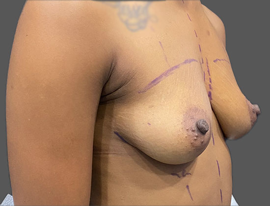 Case--5204 | Before Breast Augmentation 2