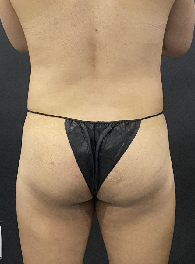 Case--6520 | Before Brazilian Butt Lift 2