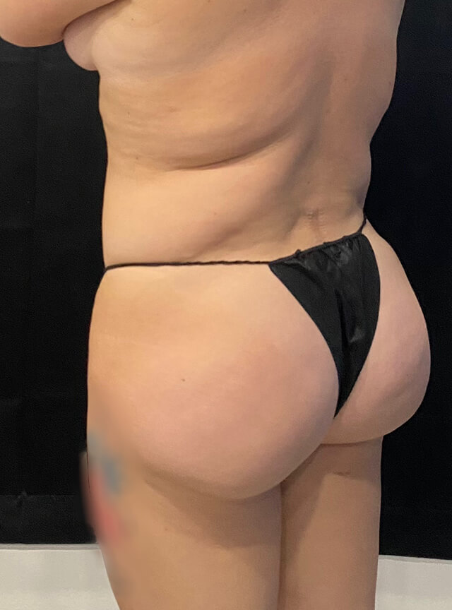 Case--4087 | Before Brazilian Butt Lift