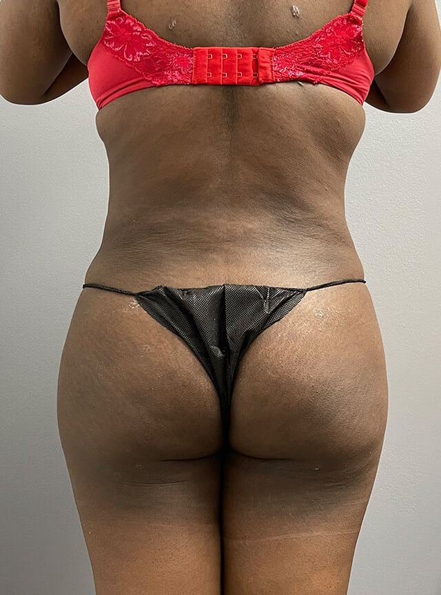 Case--4684 | After Brazilian Butt Lift