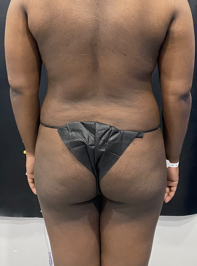 Case--4684 | Before Brazilian Butt Lift