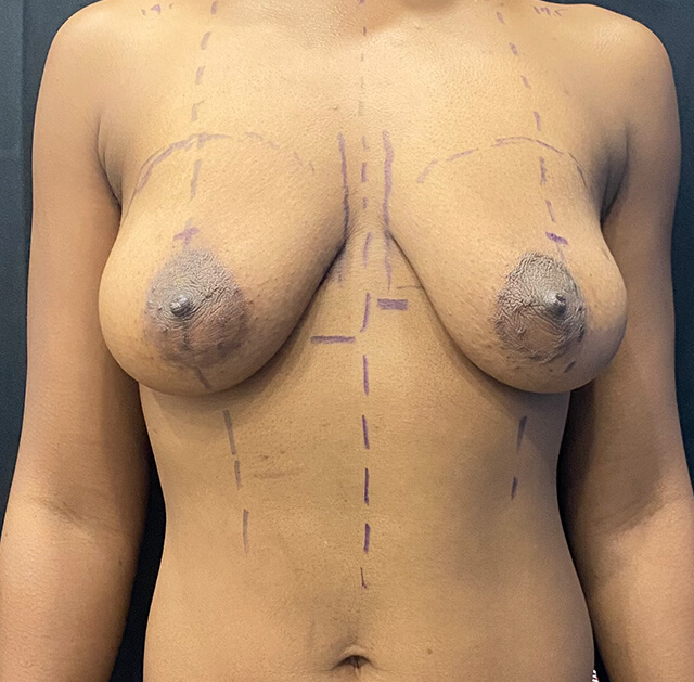 Case--7931 | Before Breast Augmentation with Lift