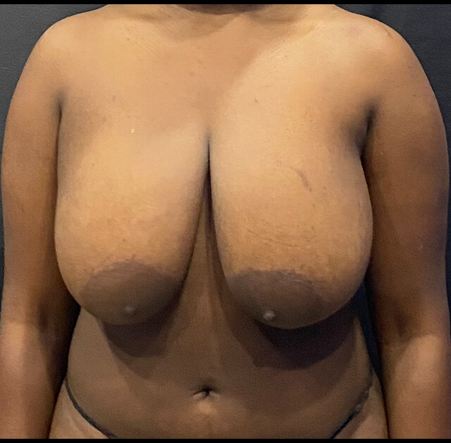 Case--8377 | Before Breast Reduction