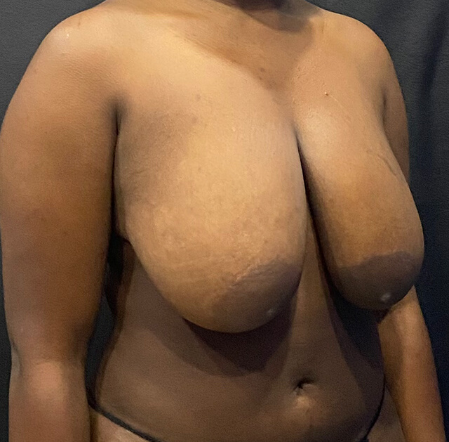 Case--8377 | Before Breast Reduction 2